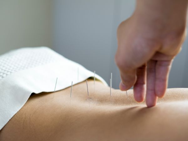 Co akupunktura może zrobić dla Ciebie i Twojego zdrowia